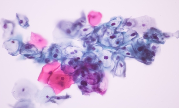HPV infection