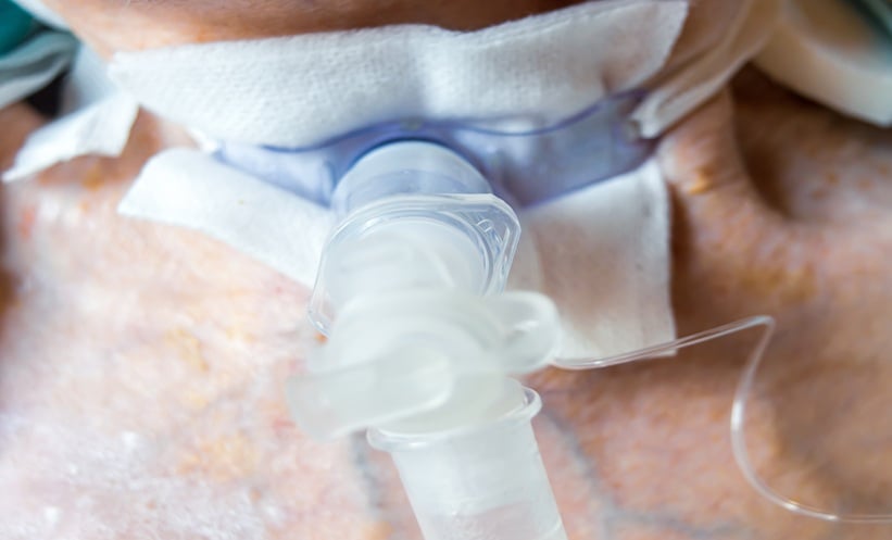 Close-up of a patient with a tracheostomy tube receiving respiratory support, illustrating research into mechanical ventilation in ARDS