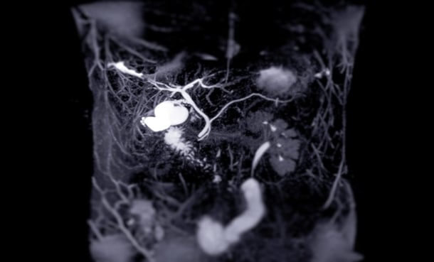 x ray showing biliary tract cancer