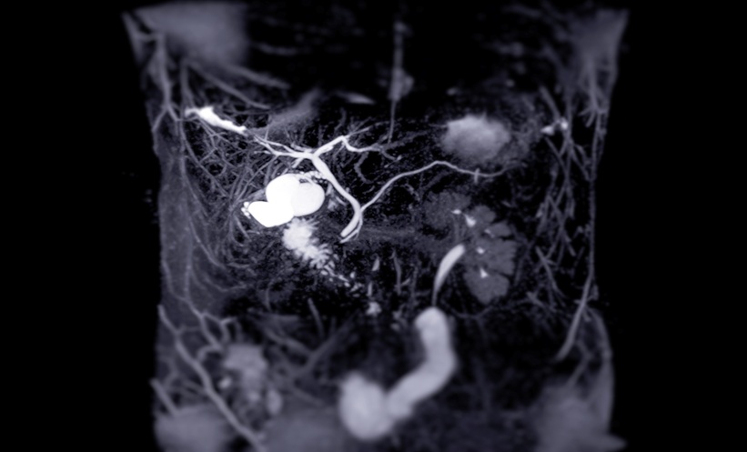 x ray showing biliary tract cancer