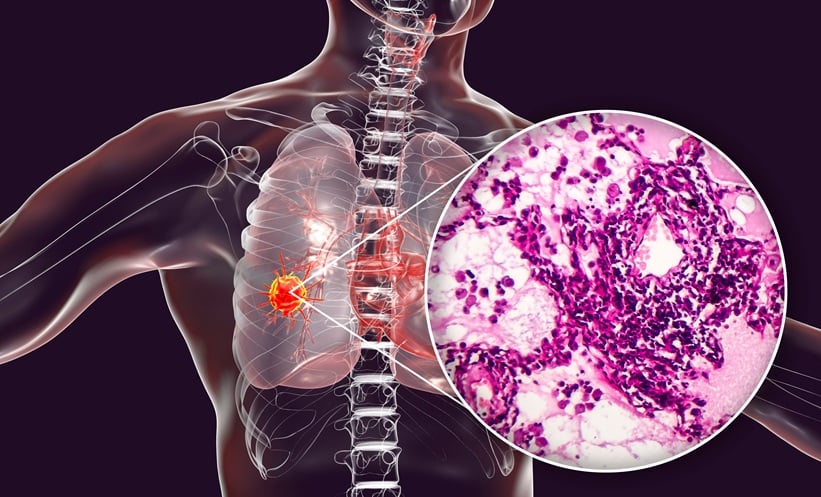Small cell lung cancer image, ESMO 2026