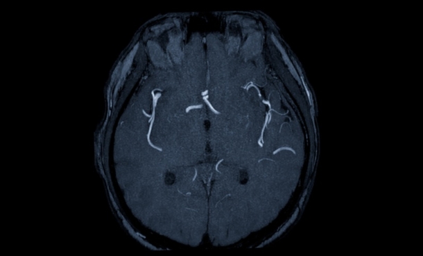 MRI of a brain