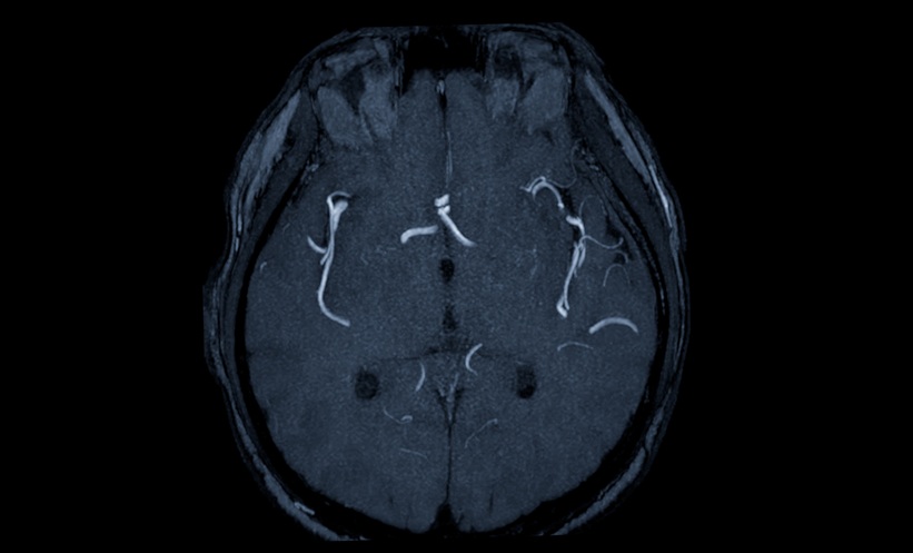 MRI of a brain