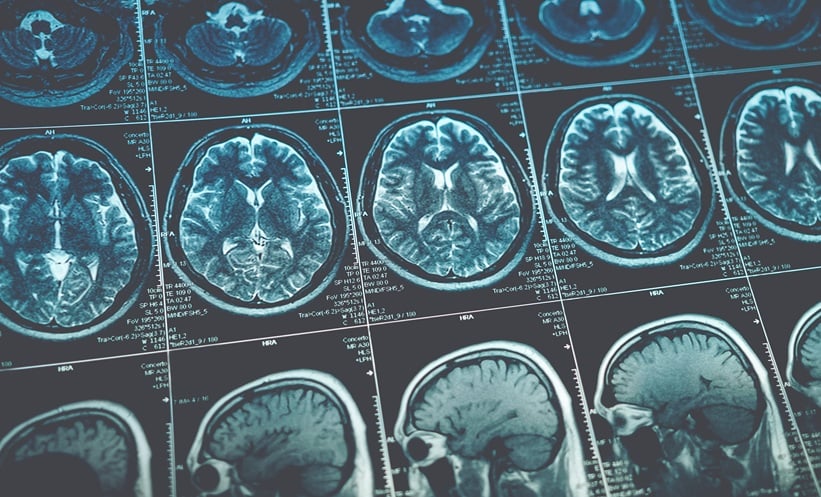 Brain scans for brain tumours and cancer