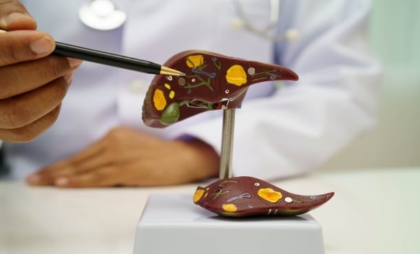 Doctor pointing with a pen at a model of a liver with with hepatocellular carcinoma