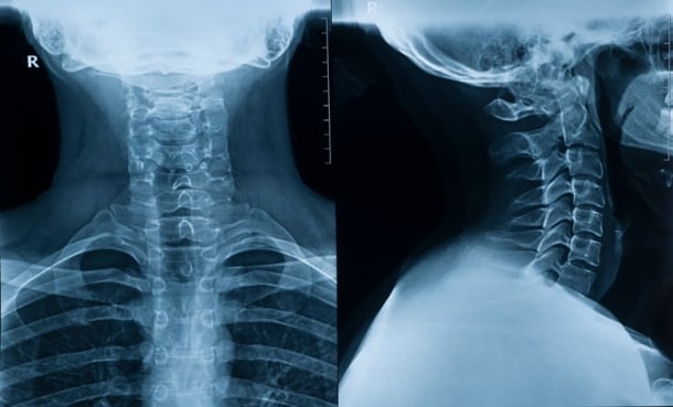 3D MRI Analysis Improves Neck Abscess Assessment -EMJ